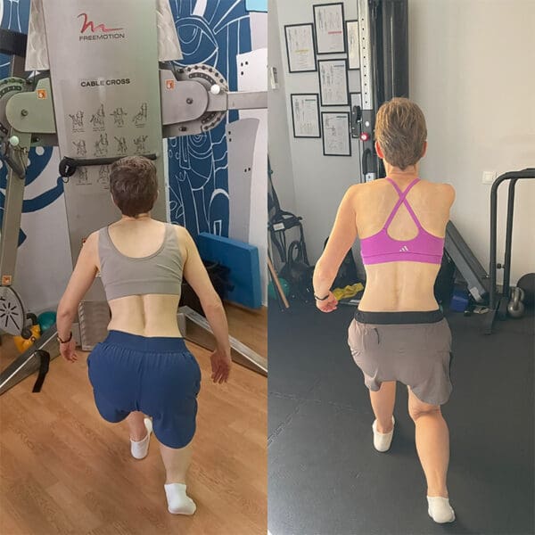 anisometria-before-after anisometria-before-after